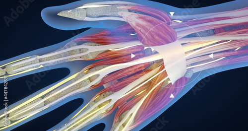 Photos Carpal tunnel syndrome, carpal tunnel syndrome, median nerve entrapment and infl