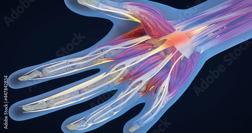 Carpal tunnel syndrome, carpal tunnel syndrome, median nerve entrapment and inflammation, hand anatomy, neurons, body tissues, 3D illustration