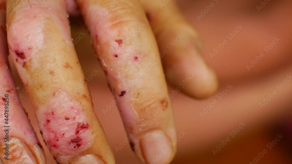 Terrible ulcers on the hands, illness Terrible ulcers on the hands, illness