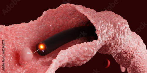 Canvas-taulu Colon Polyp Removal