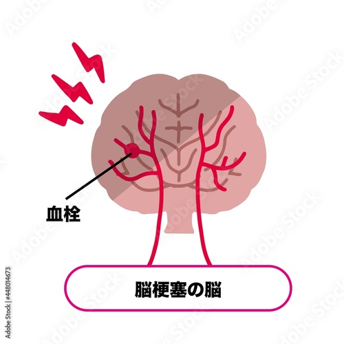 脳梗塞　血栓ができた脳のイラスト素材