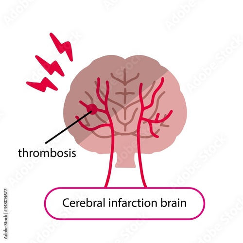 Illustration of a brain with a blood clot