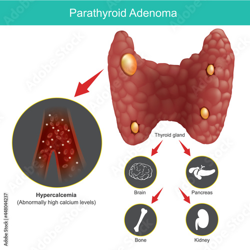 Parathyroid Adenoma. Illustration for explain abnormal thyroid gland and include effects on other organs in human body..