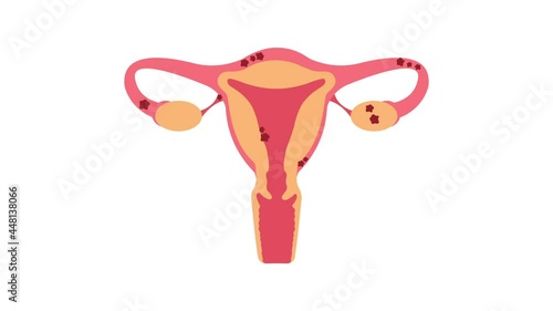 Uterus with endometriosis 2D animation on transparent background. Fertility, human anatomy, female reproductive system. Disease, gynecology, inflammation.
Outside tissue growth medical condition 