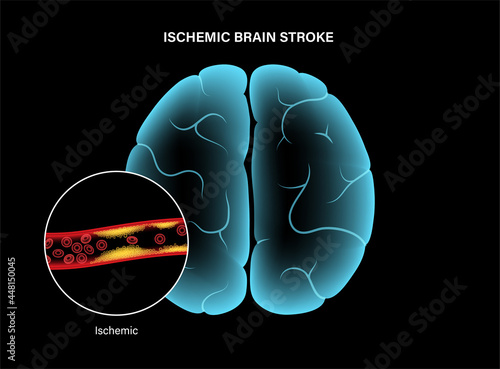 Brain stroke ishemic