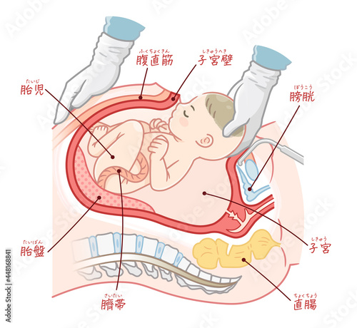 帝王切開で生まれる赤ちゃんのイラスト（テキスト付き）