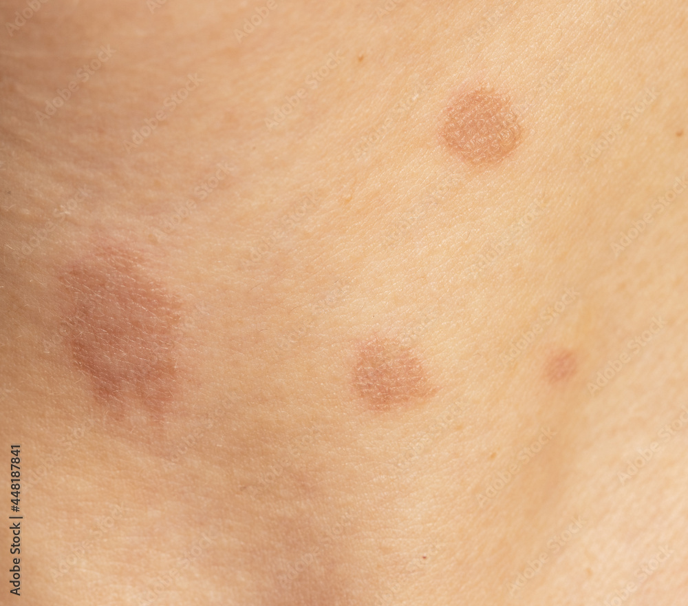 round skin burns from hot oil
