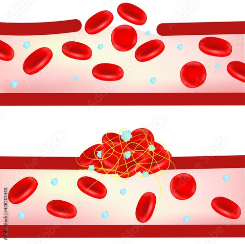 Formation of blood clots.