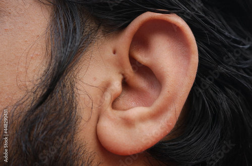 Canvastavla Small hole in front of the upper side of the ear which is known as Preauricular Pit