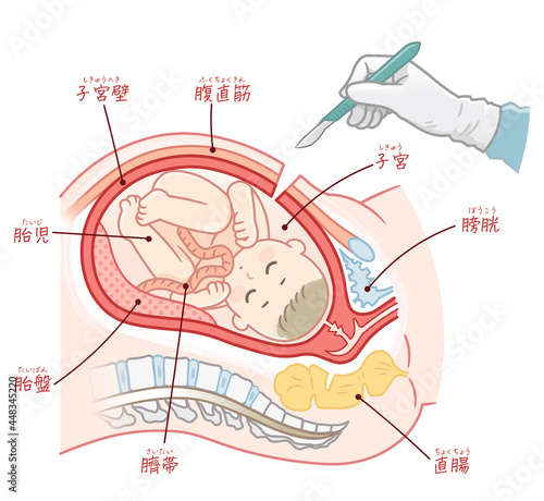 帝王切開の手術と胎児（テキスト付き）