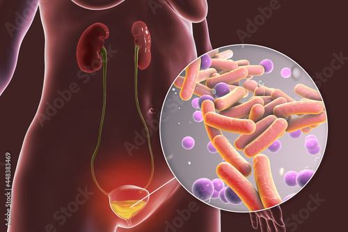 Billede på lærred Cystitis, bacterial infection of urinary bladder, conceptual 3D illustration