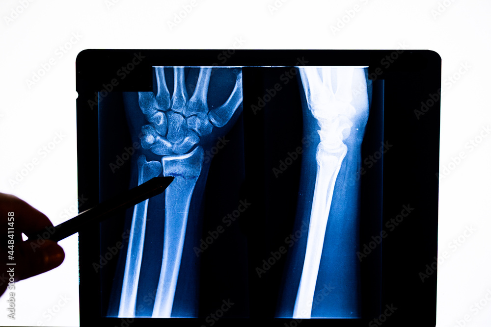 Doctor checking radiography examining xray film of patient's arm