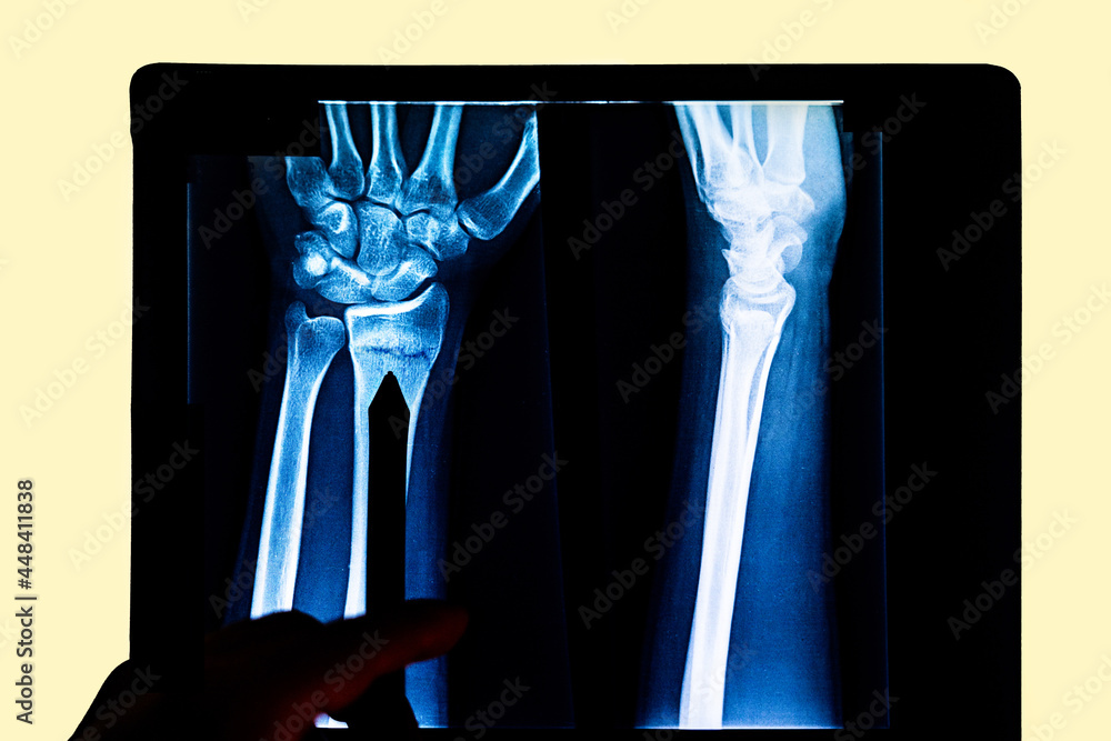radiography examining xray film of patient's arm pointing to radius