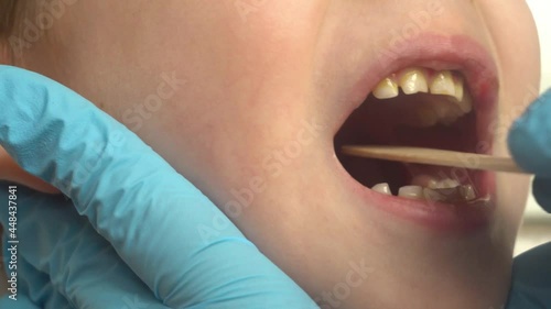 Close-up of a doctor examining a child's mouth and throat using a tongue depressor.ENT medicine.4k