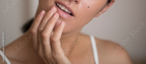 part of a woman's face , herpes on the lips, beauty concept