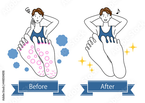 スキンケア 水虫 足裏のお肌トラブルのビフォーアフター 可愛い男性のイラスト シンプル ベクター