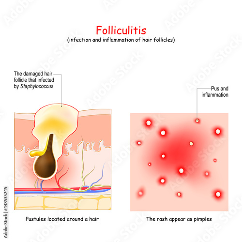 Folliculitis is infection and inflammation of hair follicles.