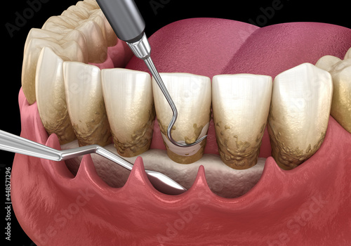 Open curettage: Scaling and root planing (conventional periodontal therapy). Medically accurate 3D illustration of human teeth treatment photo