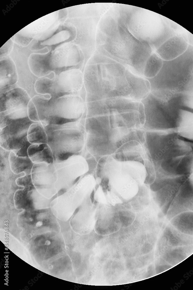 Xray examination of the large intestine (colon). Barium enema, double