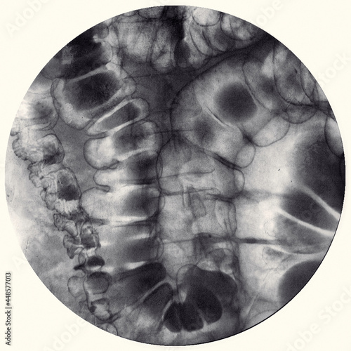 Barium enema image or x-ray image of large intestine or colon showing anatomical of large intestine and appendix for diagnosis Colorectal cancer photo