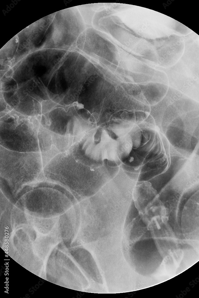 Close up xray Barium enema examination. Colorectal xray Stock Photo Adobe Stock