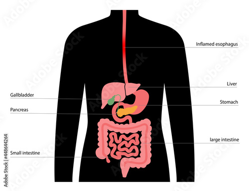 esophageal cancer concept