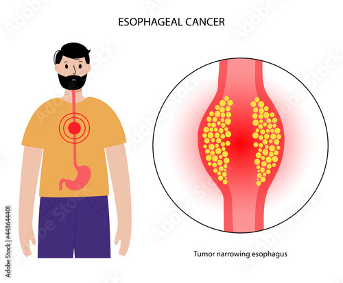 esophageal cancer concept