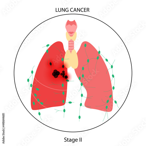 Lungs cancer disease