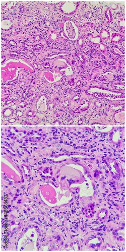 Camera photo of light chain cast nephropathy, magnification 400x in the lower and magnification 200x in the upper, photograph through a microscope