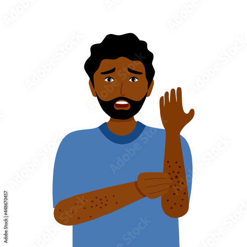 Young black man scratching arm. African guy suffering from strong allergy skin itchy symptom in flat design. Red rash skin irritation.