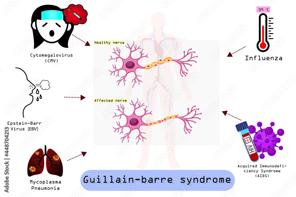 Guillain-Barre (gee-YAH-buh-RAY) syndrome is a rare disorder in which your body's immune system attacks your nerves.