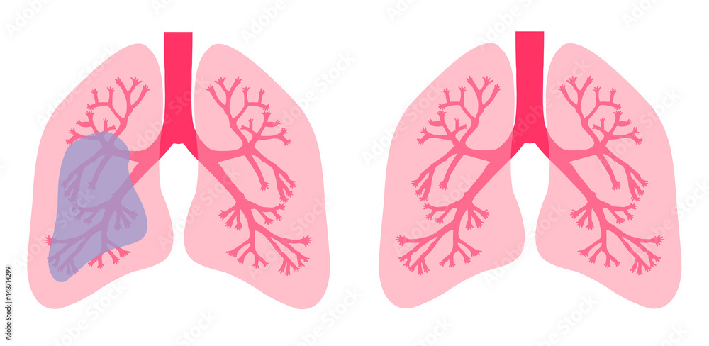Human lungs are healthy and contaminated. White background. Human lung pneumonia concept.
