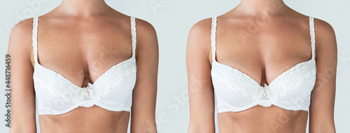 Fotografie Comparison before and after breast asymmetry correction surgery