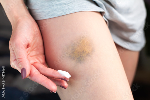 A young woman applies a healing cream to a bruise on the leg. Treating a bruise at home. Domestic violence. Close-up.
