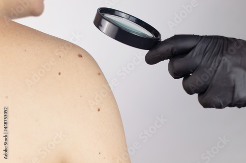 A man at a dermatologist appointment shows his birthmarks, moles and nevi. The doctor examines the patient with a dermatoscope. Benign and malignant birthmarks. Skin abnormalities care concept photo
