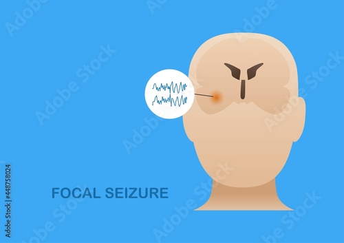 Focal seizure from temporal lobe