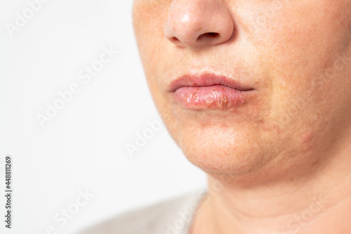 Young woman suffering from herpes on her lips. Concept skin problem, allergy and dermatology.