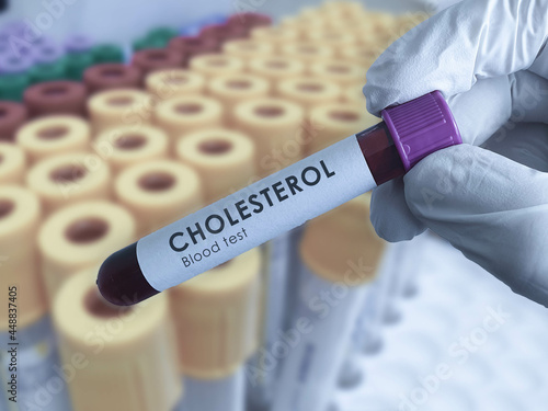 Cholesterol blood test photo