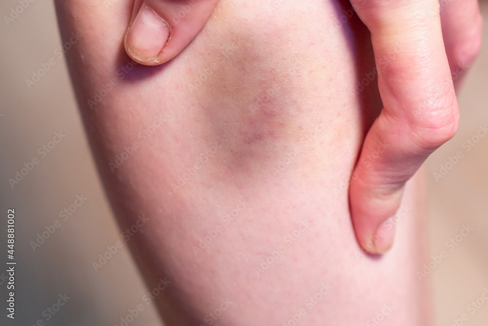 Bruise on the leg of a young girl. Bruise on the leg of a young girl.