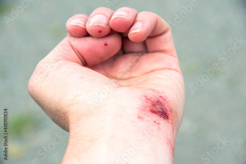 Red wound on the palm, hand, wrist after a burn or fall, close-up. First aid in wound treatment