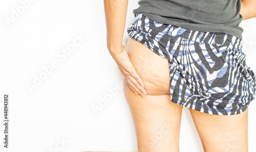 Women's posterior thigh muscles that are flabby due to cellulite that accumulates under the skin in large quantities.