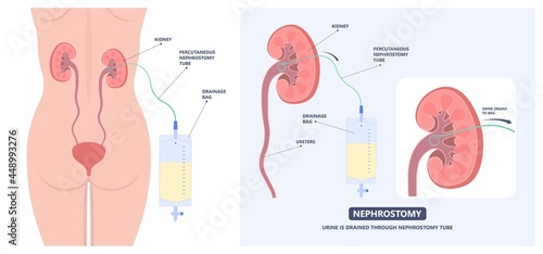 Tube Stent bag blocked kidney stone tumor urine urinary Drain renal ileal conduit stoma foley bladder pelvis Obstructive ureter shock wave ESWL pain cystitis remove surgery pee Cancer tract transplant photo