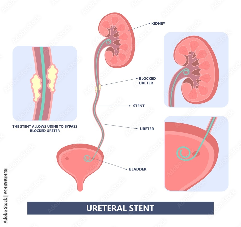 Tube Stent bag blocked kidney stone tumor urine urinary Drain renal