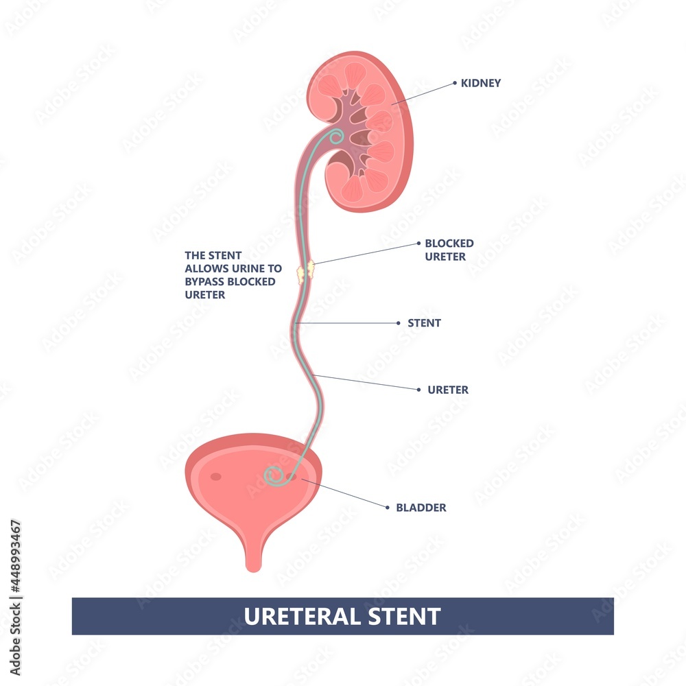 Tube Stent bag blocked kidney stone tumor urine urinary Drain renal