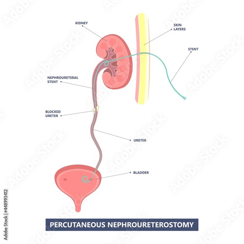 Tube Stent bag blocked kidney stone tumor urine urinary Drain renal ileal conduit stoma foley bladder pelvis Obstructive ureter shock wave ESWL pain cystitis remove surgery pee Cancer tract transplant