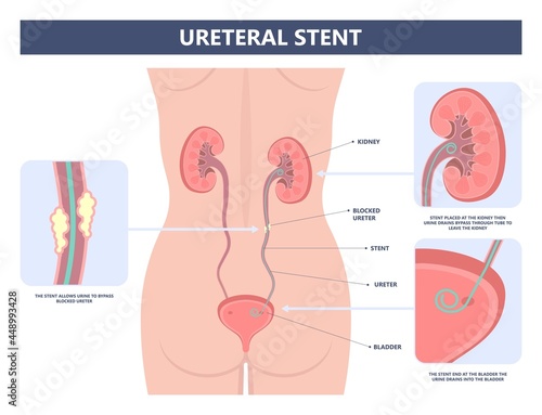 Tube Stent bag blocked kidney stone tumor urine urinary Drain renal ileal conduit stoma foley bladder pelvis Obstructive ureter shock wave ESWL pain cystitis remove surgery pee Cancer tract transplant