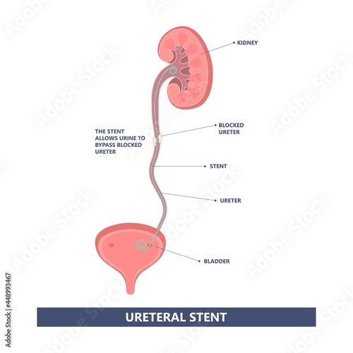 Tube Stent bag blocked kidney stone tumor urine urinary Drain renal ileal conduit stoma foley bladder pelvis Obstructive ureter shock wave ESWL pain cystitis remove surgery pee Cancer tract transplant