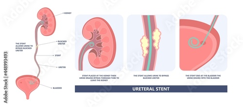 Tube Stent bag blocked kidney stone tumor urine urinary Drain renal ileal conduit stoma foley bladder pelvis Obstructive ureter shock wave ESWL pain cystitis remove surgery pee Cancer tract transplant