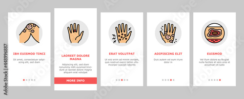 Eczema Disease Treat Onboarding Mobile App Page Screen Vector. Nummular And Neurodermatitis Eczema Treatment, Dry Skin And Pain, Contact And Atopic Dermatitis. Illustrations