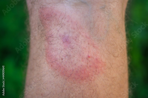 migrating erythema after a tick bite on a man\'s leg. a symptom of tick-borne borreliosis. a red ring in the form of a target on the leg